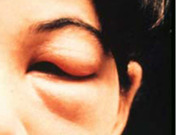 Chagas: A Tropical Disease Born in the Home